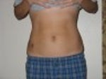 2 months after smart lipo - front